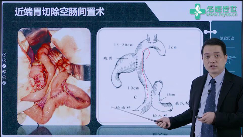 李勇:全腹腔镜下胃癌根治术的消化道重建