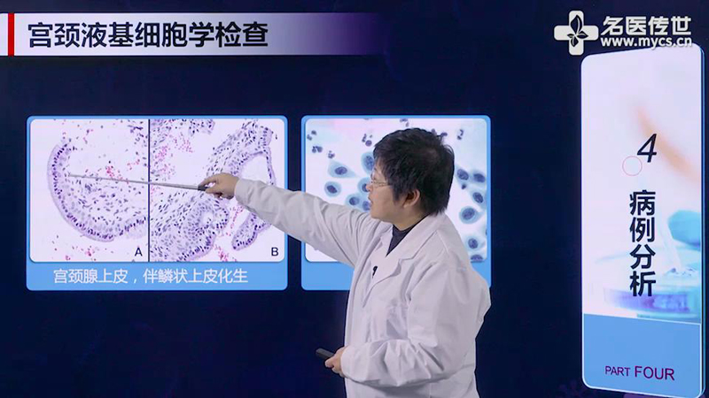 郝卓芳:液基细胞学诊断