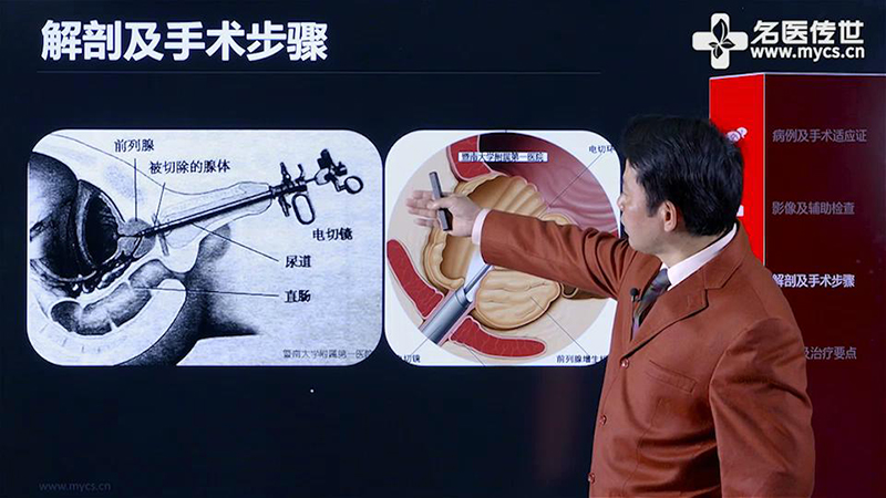 卓育敏:经尿道前列腺等离子电切术