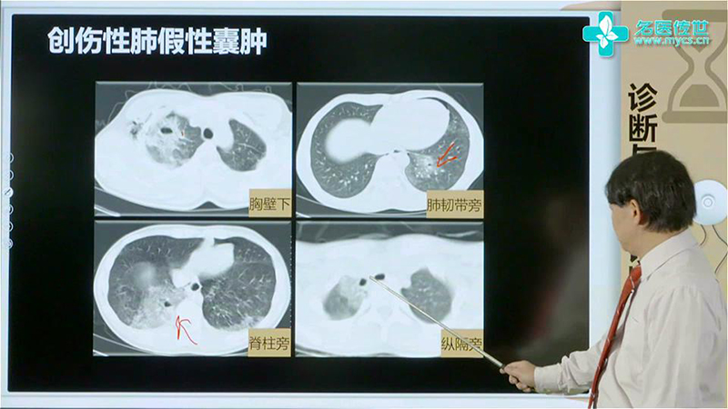 罗良平:创伤性肺假性囊肿的ct表现