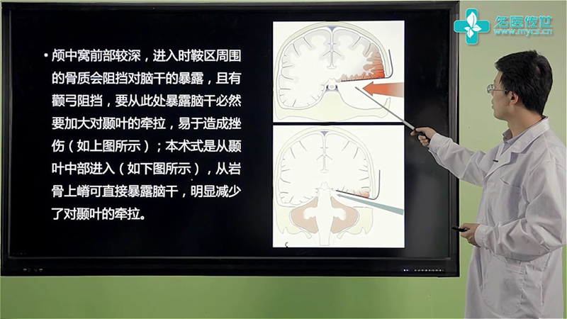 张洪钿:颞下入路显微手术治疗脑干出血