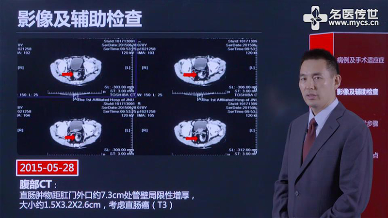 龚瑾:腹腔镜低位直肠癌根治术(dixon手术)