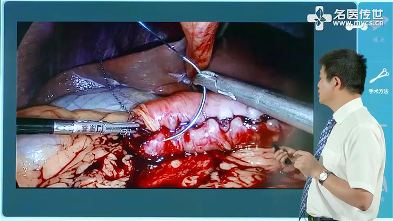王存川:腹腔镜袖状胃切除术