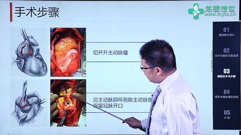 许李力:升主动脉夹层vsrr手术治疗