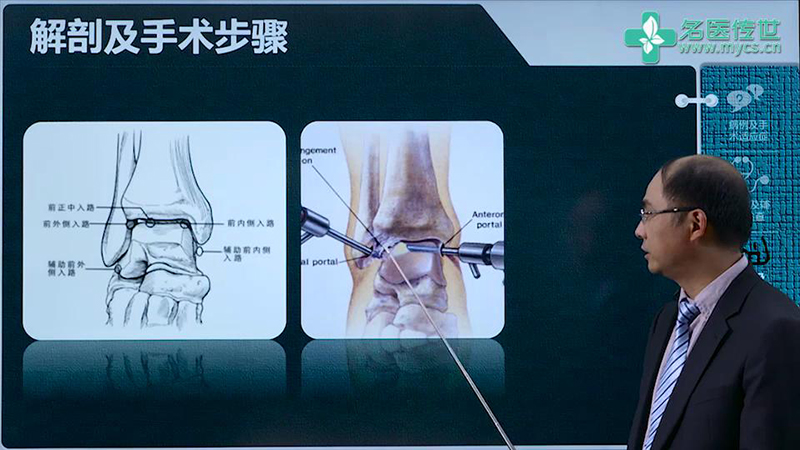 程飚:距腓韧带 跟腓韧带修补术